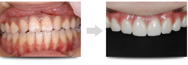 ラミネートべニア