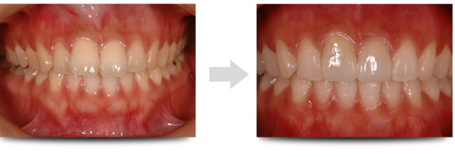 オールセラミック