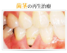 歯茎の再生治療  
