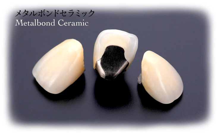 メタルボンドセラミック / Metalbond Ceramic