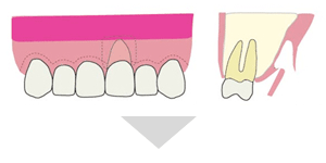 Step2：歯肉の移植