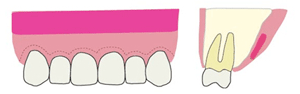 Step3：歯茎の縫合
