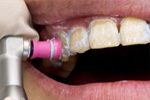 歯面の清掃